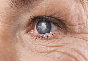 Close-up of an eye with Cataracts