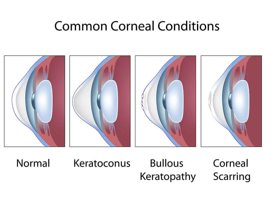 Common Conditions that Affect the Cornea