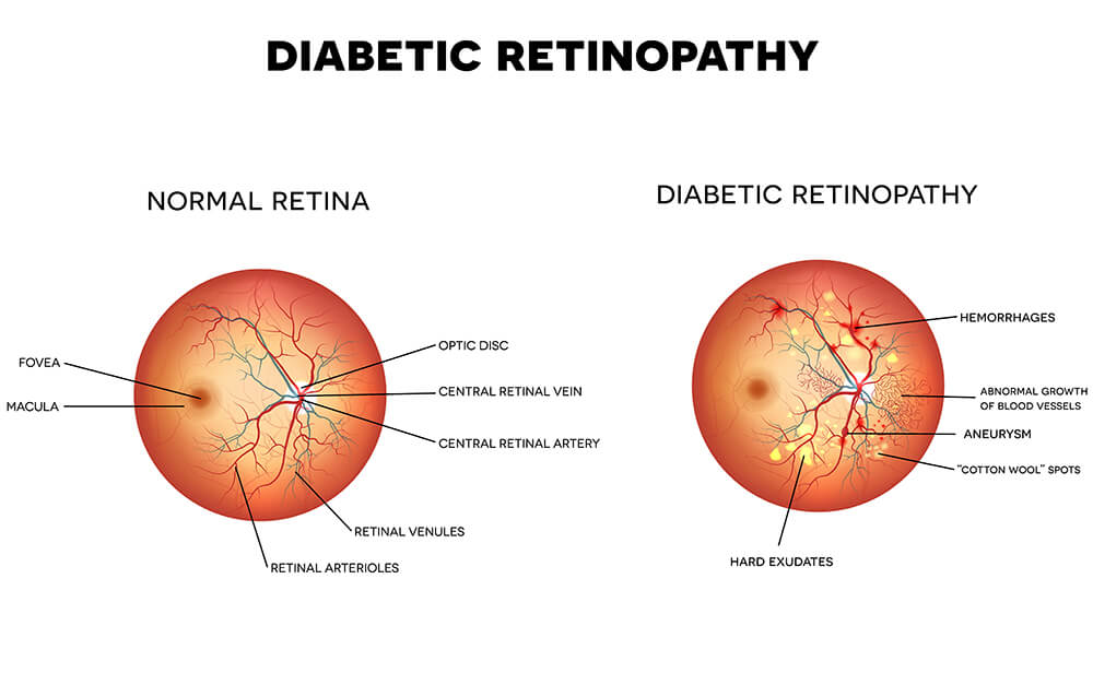 Chart Illustrating How Diabetic Retinopathy Affects the Eye