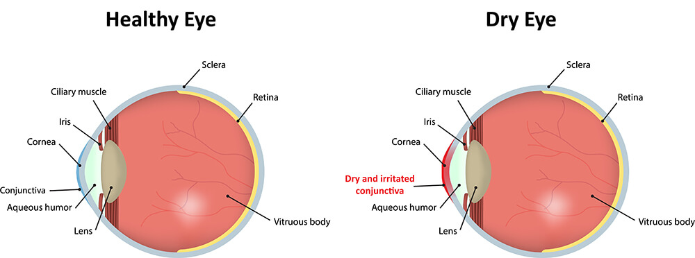 Dry Eyes Chart