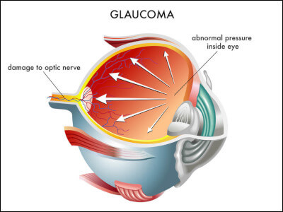 Glaucoma Chart