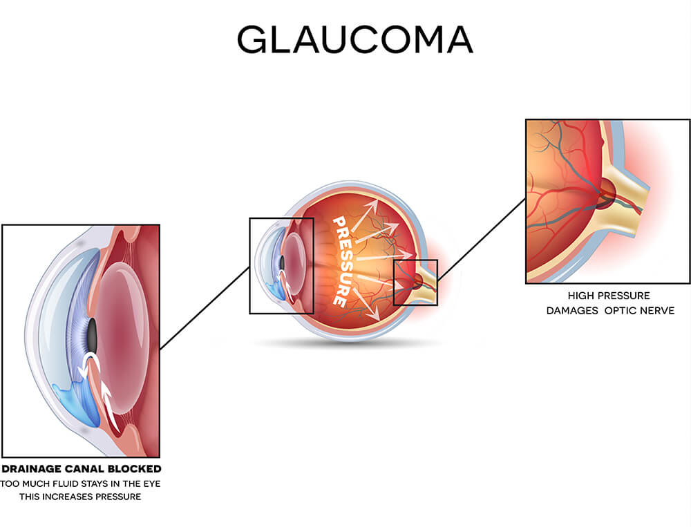 Chart Illustrating How Glaucoma Affects the Eye