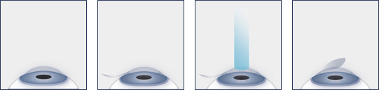 LASIK Eye Surgery Procedure Diagram