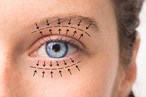 Closeup of an Eye that is Being Prepped for Oculoplastic Surgery