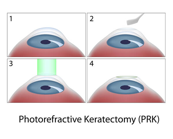 Chart Illustrating the Process of PRK Surgery