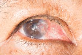 Pterygium Example