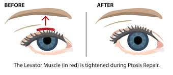 Chart Illustrating Before and After Ptosis Surgery