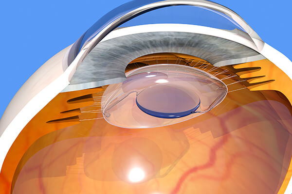 Refractive Lens Exchange Procedure Diagram